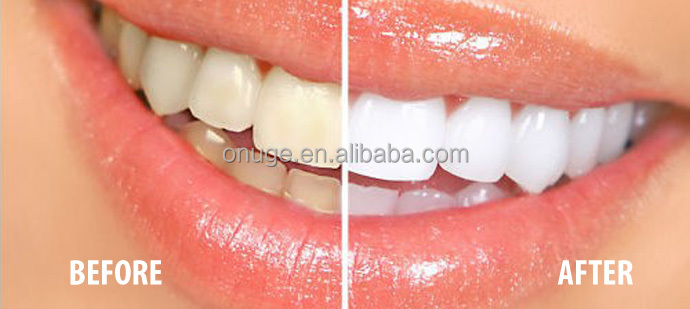 coconut oil teeth whitening gel strips no slip