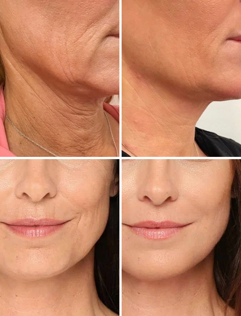 RADIESSE Calcium fillers for facial contouring - Sapiegos clinic