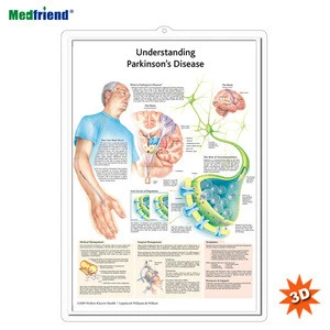 Licensed Educational Plastic 3D Medical Anatomical Wall Chart /Poster  - Understanding Parkinson&#39;s Disease