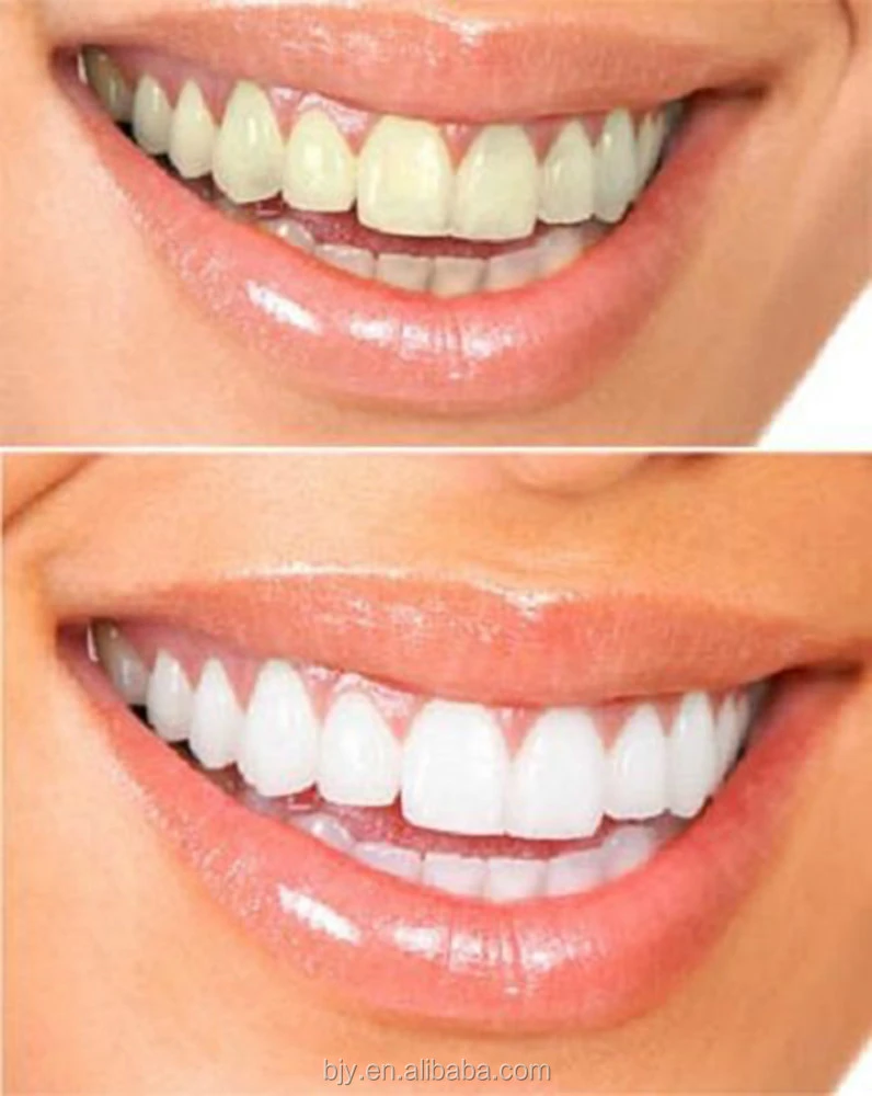 Dental teeth whitening gel syringe home use teeth whitener gel 35% hydrogen peroxide