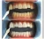 LED blue laser teeth whitening machine/ dental bleaching/dental whitener/teeth whitening lamp  With Wheels