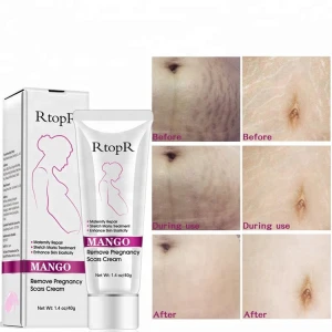 RtopR brand Mango Remove pregnancy scars cream Stretch marks treatment skin care cream