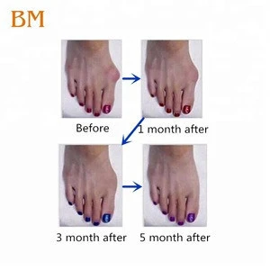 Medical Gel Bunion Corrector Toe Foot Splint Hallux Valgus Silicone Toe Separator
