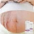 RtopR brand Mango Remove pregnancy scars cream Stretch marks treatment skin care cream