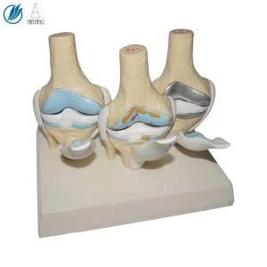 Human Four-Stage Diseased Knee Joint Model
