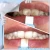 Import Innovation Tooth Whitening Brands Non peroxide Dental Teeth Whitening Kits from China