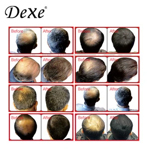 DEXE brand best quality Anti-hair loss scalp lotion to grow hair treatment