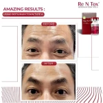 Rentox 100u 200u anti wrinkles liztox botatox refine korea botox neotox Wiztox nabota Dysport