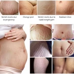 VIBRANT GLAMOUR 30ml Body care Remove Stretch Marks repair Cream Maternity Skin Repair Scars obesity lines Skin firm smooth Body