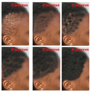 Private label bald hair growth Hair follicle regrowth Germinal Serum Essence Oil