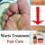 Body Warts Treatment Cream Skin Tag Remover Foot Corn Removal Plantar Genital Warts Ointment Foot Care Cream