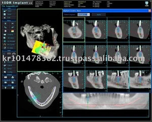Implant Software - CT