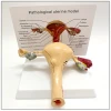Standard price medical anatomical uterus teaching models of the uterine leiomyomas