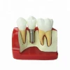 HOT SALES dental implant model medical restoration model Manufactory implant teeth model in science