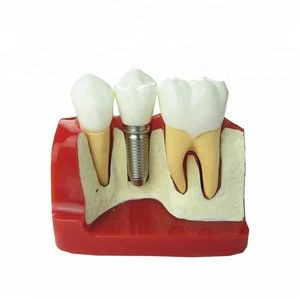 HOT SALES dental implant model medical restoration model Manufactory implant teeth model in science
