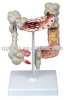 Colon Diseases medical gift model (anatomical model,educational model)
