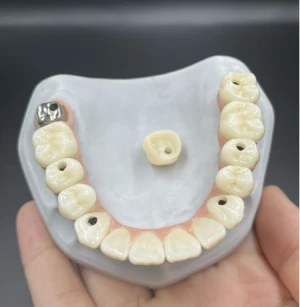 China Screw Retained Implant BridgeGood quality comes initial