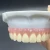 Import China Screw Retained Implant BridgeGood quality comes initial from China