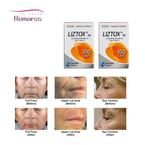 Korea Rentox 100u200u botulinum toxin injection Botulax Meditoxin Nabota to improve glabella wrinkles