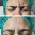 Import Bijutox 100u Low-cost add ice transportation of Botox in South Korea from China