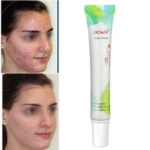OEM/ODM 25g Ochelli Best Pimples Removal Face  Anti Acne Face Cream