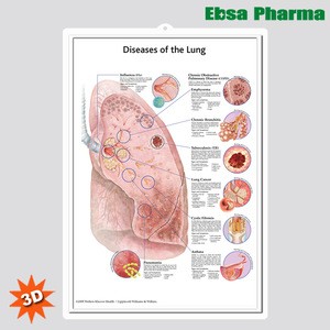 3D Medical Human Anatomy Wall Charts / Poster - Diseases of the lung