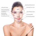 CE ISO approved hyaluronic acid dermal filler for the face injection