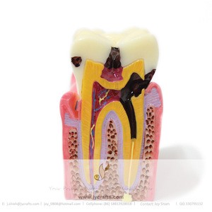 dental educational science caries teeth model