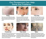 q-switched nd yag laser lens tip easy carry facial rejuvenation hair removal pigmental removal picosure laser equipment