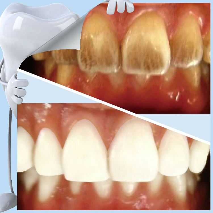 100% Safe New Technology Product in China Dental Teeth Cleaning, Best Whitening Products
