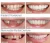 Import Snap On Instant Smile Perfect Smile  False Teeth Dental Veneers Dentures Fake Tooth from China