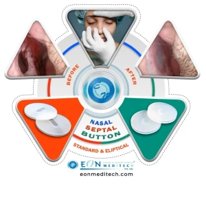 Nasal Septal Button