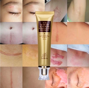 LanBeNa Best Selling Skin Care Dark Spot Whitening Acne Free gel Face Acne Scar Removal Cream 30ml