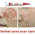 Import best clinic products scar removal cream 30g from China