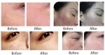 rf fractional gold micro needle system / radio frequency machine / skin care beauty salon equipment