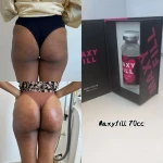 2025 Maxy Fill Maxyfill 70ml Breast Filler Butt Filler Butter Buttock Filler