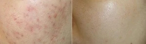 GANA DM ,plla hyaluronic acid + hyaluronic acid mesotherapy solution mesotherapy whitening acne rejuvenation for skin care
