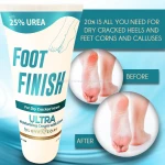 Extraordinary pain relief agent Urea Cream with 25% for skin disorders