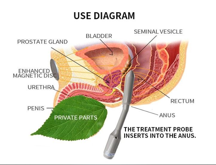 Proact Prostate Buy Male Digital Physical Therapy Prostate Equipment/medical Physical ...