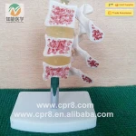ISO Certificate human osteoporosis medical anatomy teaching model