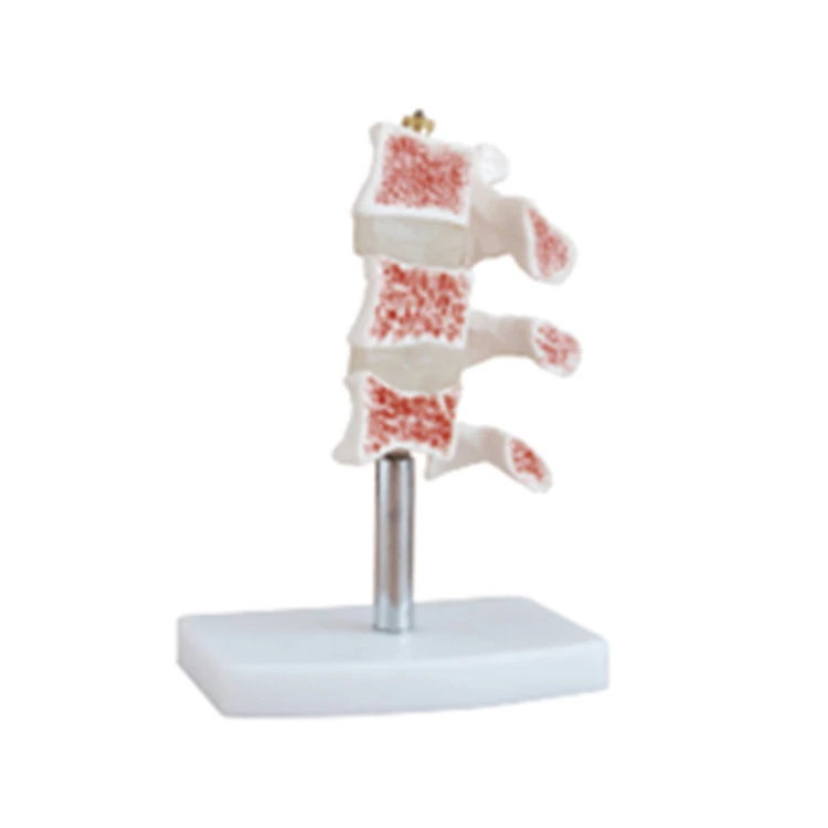 Human Life Cutaway Osteoporosis Joint Simulation Model Medical Anatomy Model
