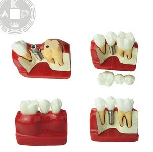 dental implant model medical restoration model implant teeth model