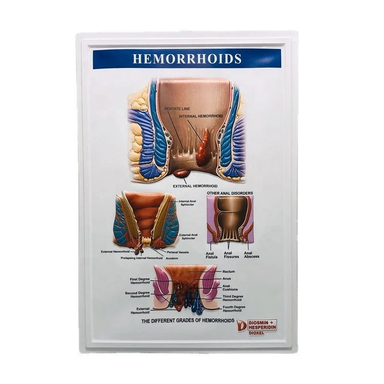 Promotion plastic Charts 3d Blister Embossed Picture Medical 3D PVC Wall Poster HEMORRHOIDS