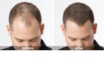Customized service FGF-7 serum hair loss solution
