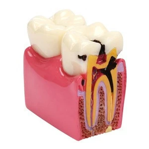 Dental study model  plastic periodontal teeth human medical decay teeth model anatomy teeth