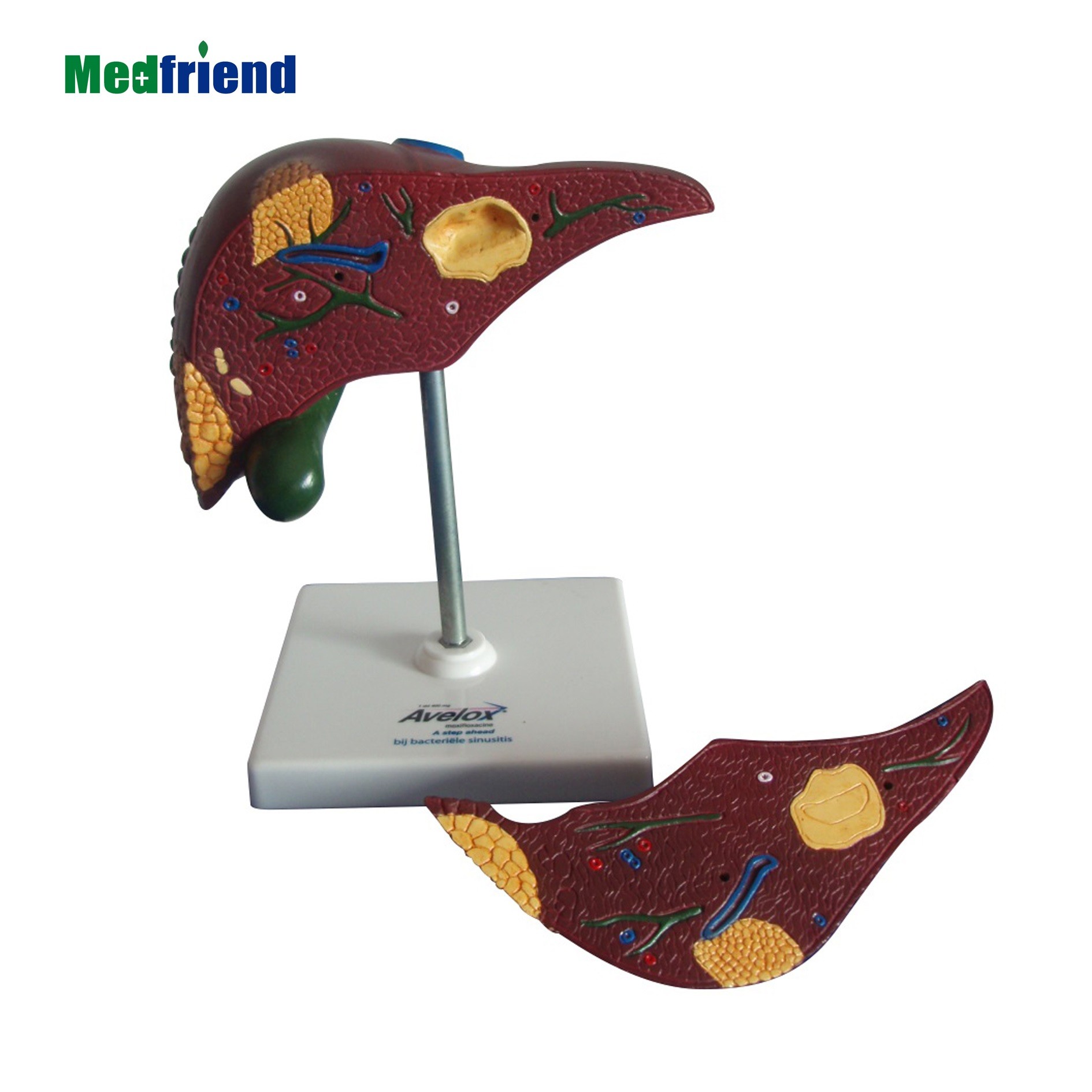 Human Liver Pathological Model  Liver Cancer For School Medical Teaching Display Tool Lab Equipment