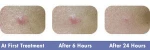 Other Beauty pen shape acne treatment device Beauty Equipment