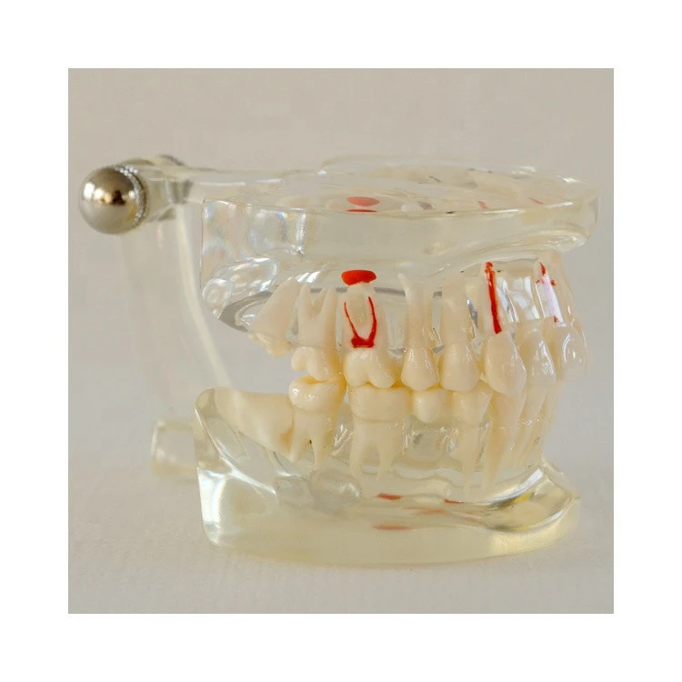 Dental teaching Pathology Model with Implant