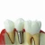 Import HOT SALES dental implant model medical restoration model Manufactory implant teeth model in science from China