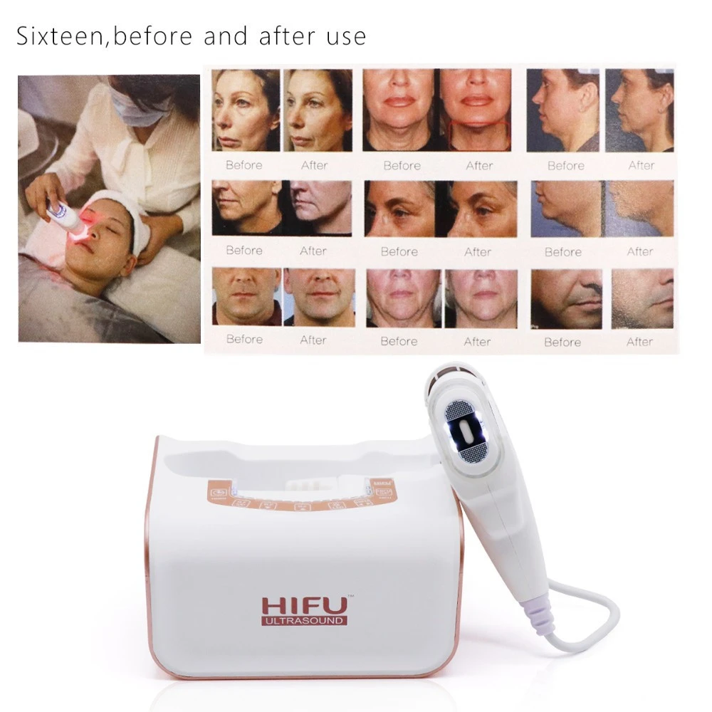 2019 mini 3d Hifu Face Lift Skin Tightening SMAS treat wrinkle remover hifu machine